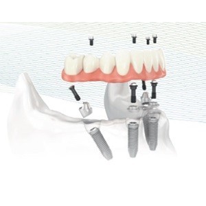 Imagem do produto Mude o seu sorriso de um dia para o outro 2